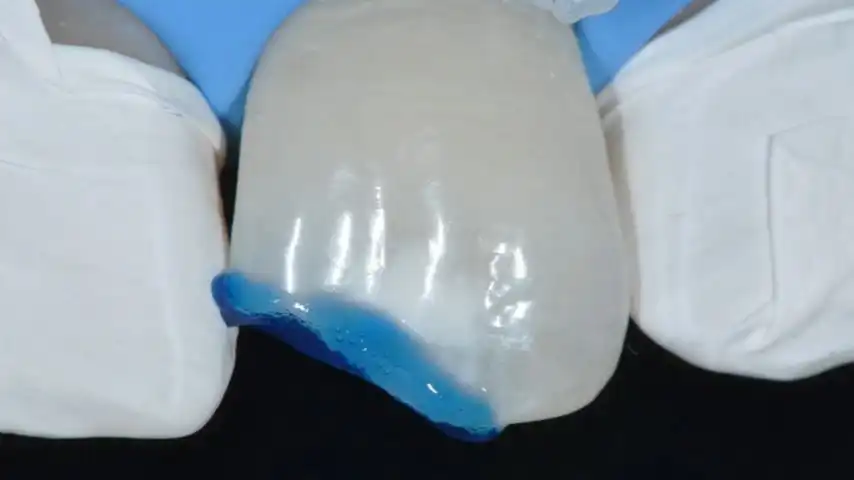 Tooth fragment reattachment