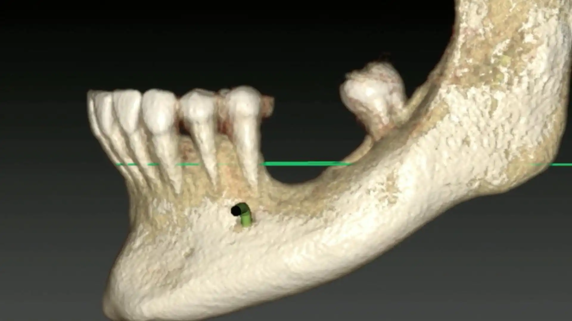 ReLIVE surgery - Vertical ridge augmentation of the posterior mandible ...