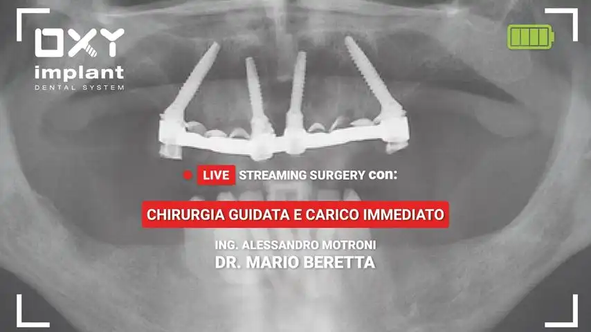 Chirurgia guidata e carico immediato