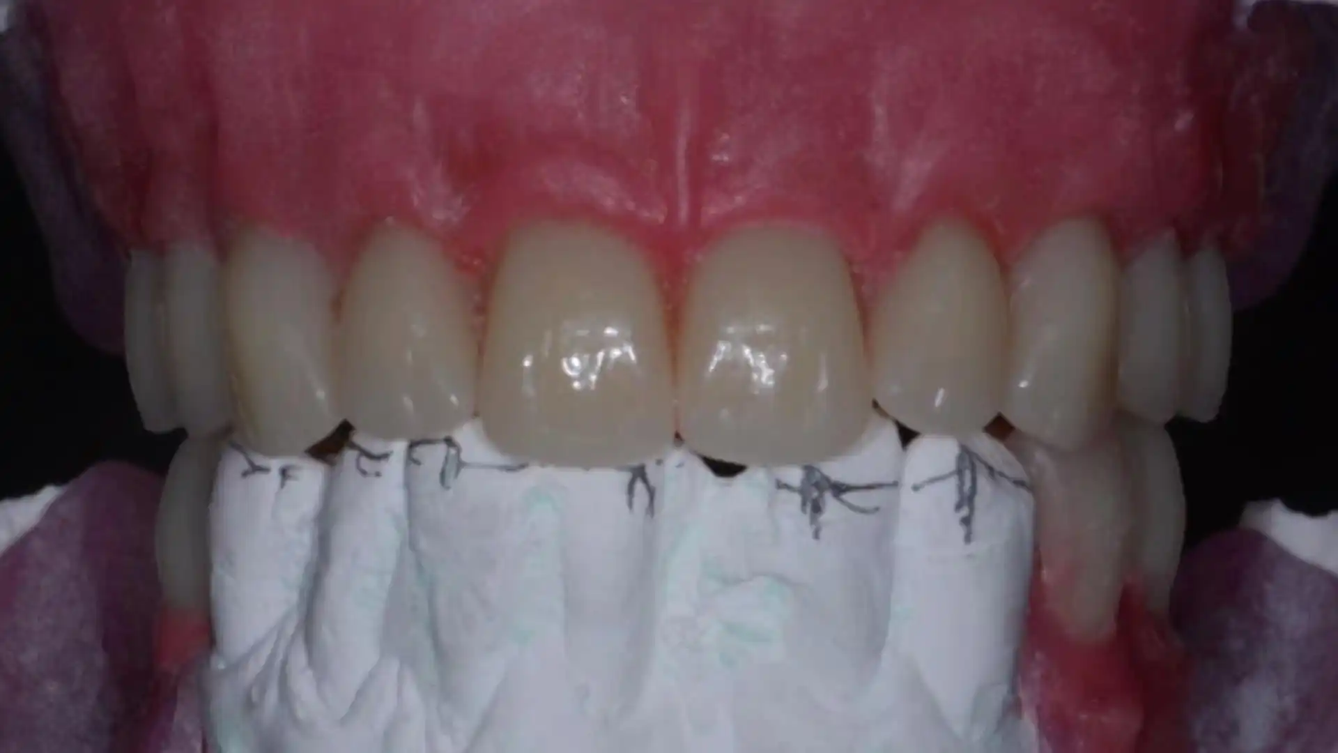 Provisionalization in All on 4® implant rehabilitation