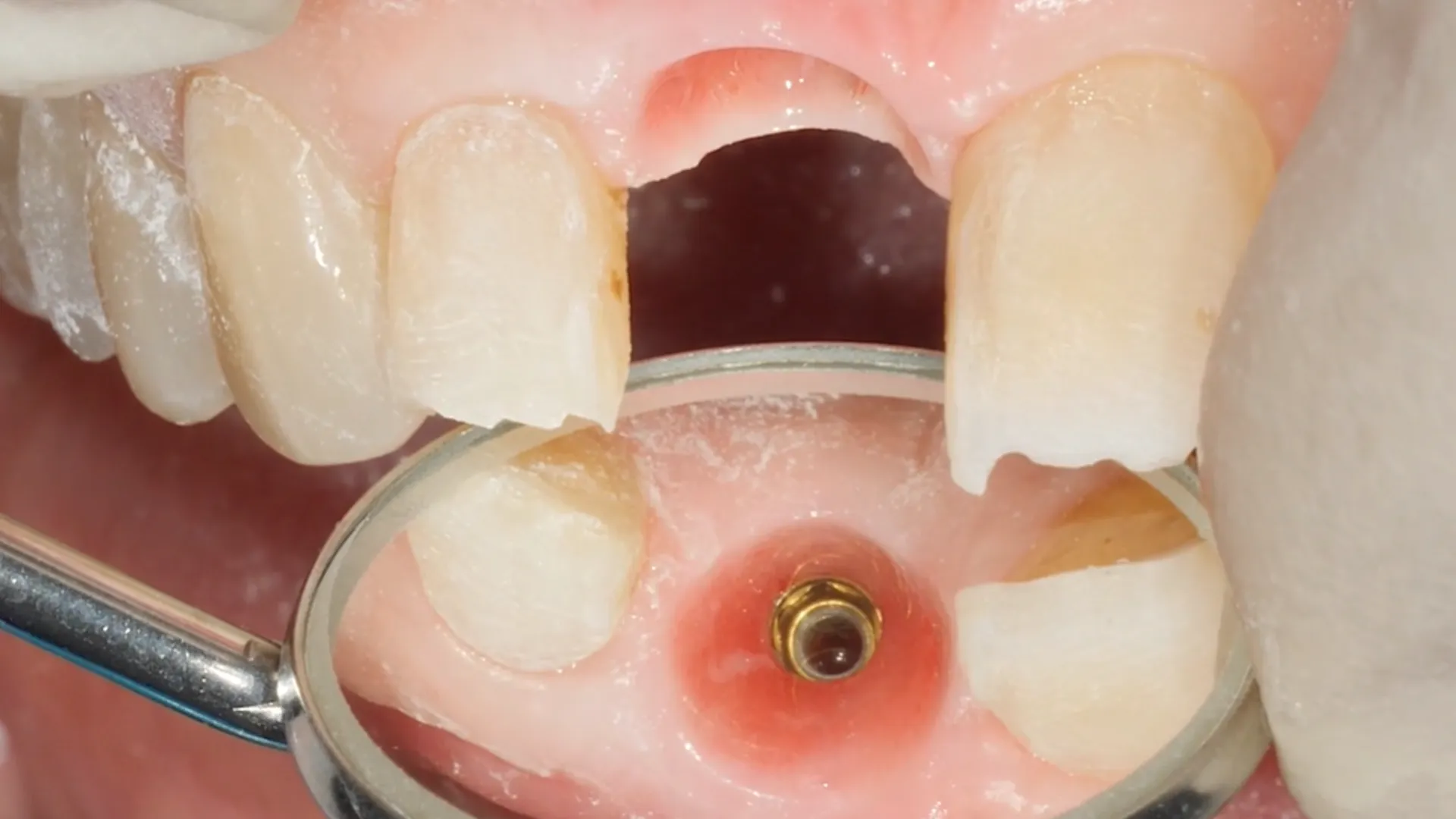 Clinical video provisionalization