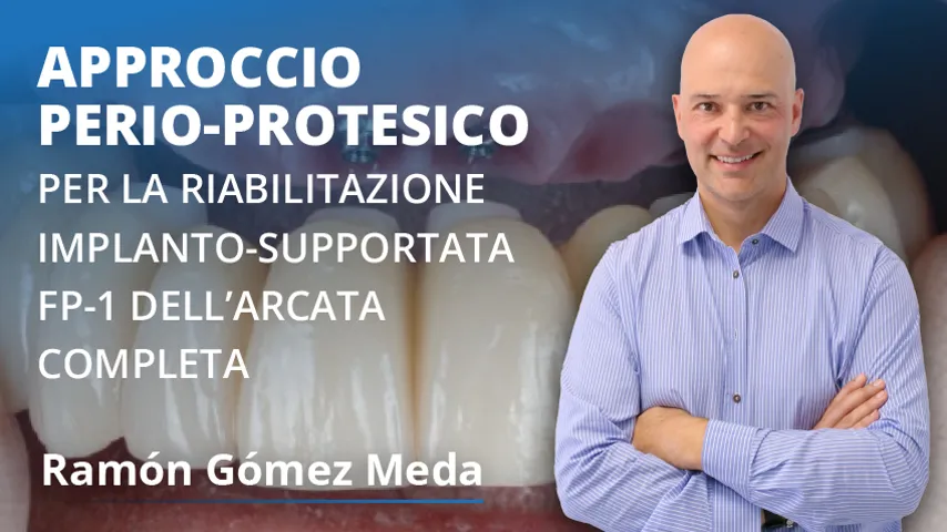Approccio perio-protesico per la riabilitazione implanto-supportata FP-1 dell'arcata completa