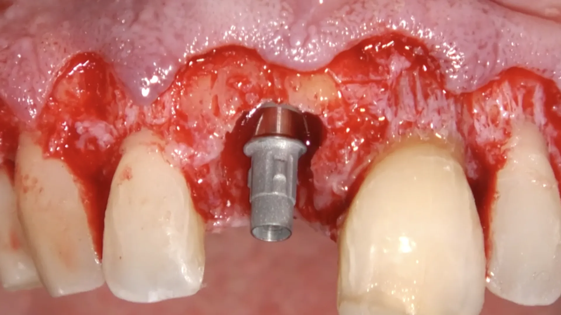 Immediate post extractive implant placement in the central incisor with