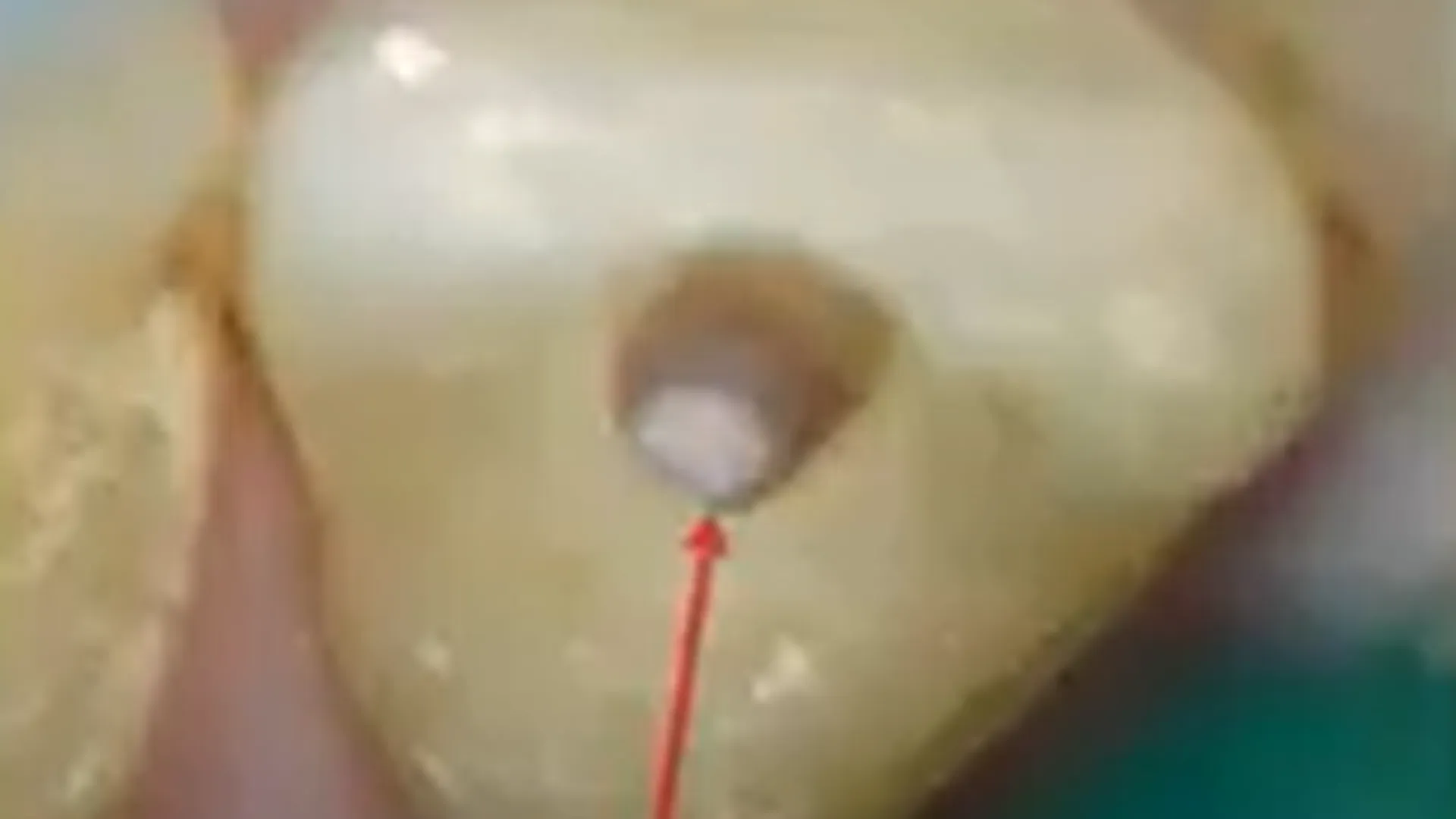 MTA-based protocols and key strategies for successful endodontic ...