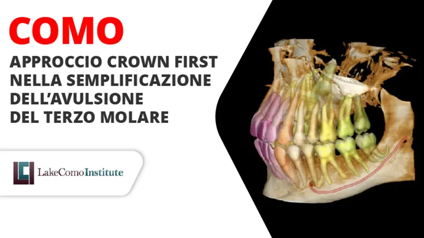 Approccio Crown First nella semplificazione dell’avulsione del terzo molare - seconda edizione Novembre 2026