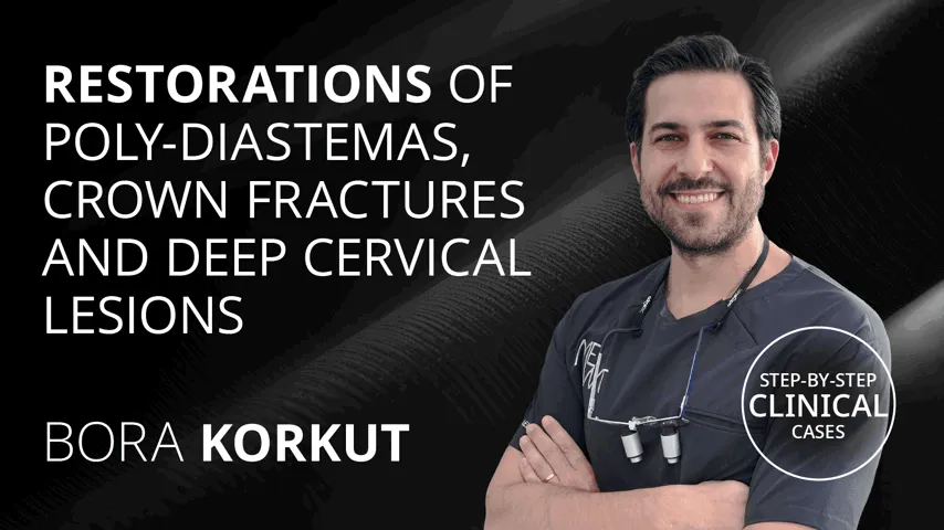 Restorations of Poly-Diastemas, Crown Fractures and Deep Cervical Lesions