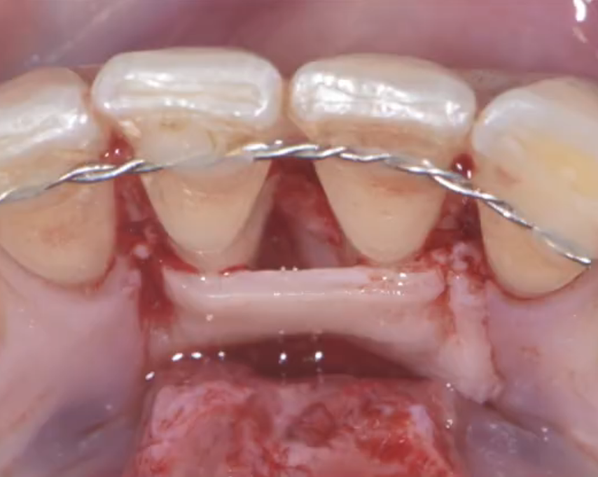Flap positioned as a containing biological wall over the graft