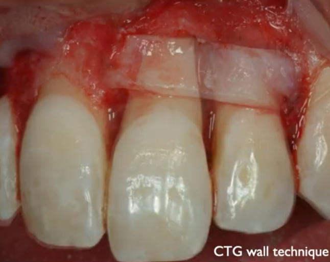 Esthetic result of the Soft Tissue Wall Technique in the upper anterior region