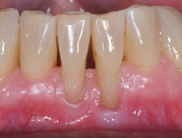 Gingival recession on the lower incisors with a shallow vestibule