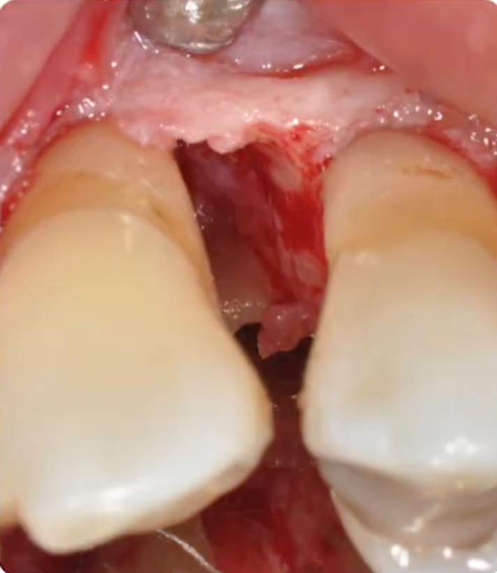 Deep periodontal bone defect before the Soft Tissue Wall Technique