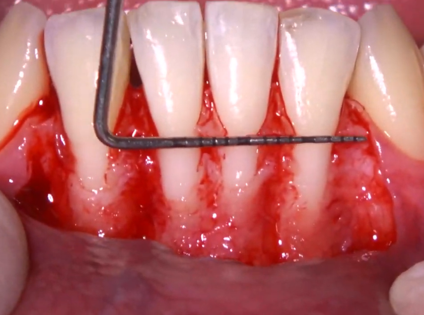 The coronally advanced flap in a clinical case