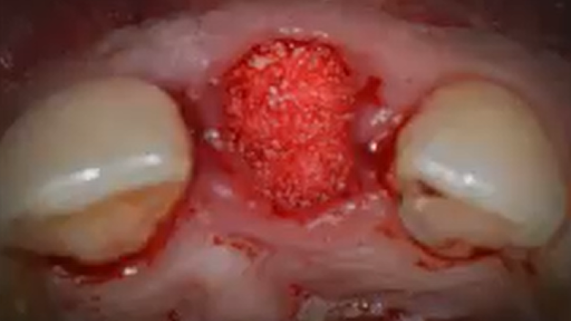 Classification of Mandibular Atrophies and Treatment Planning