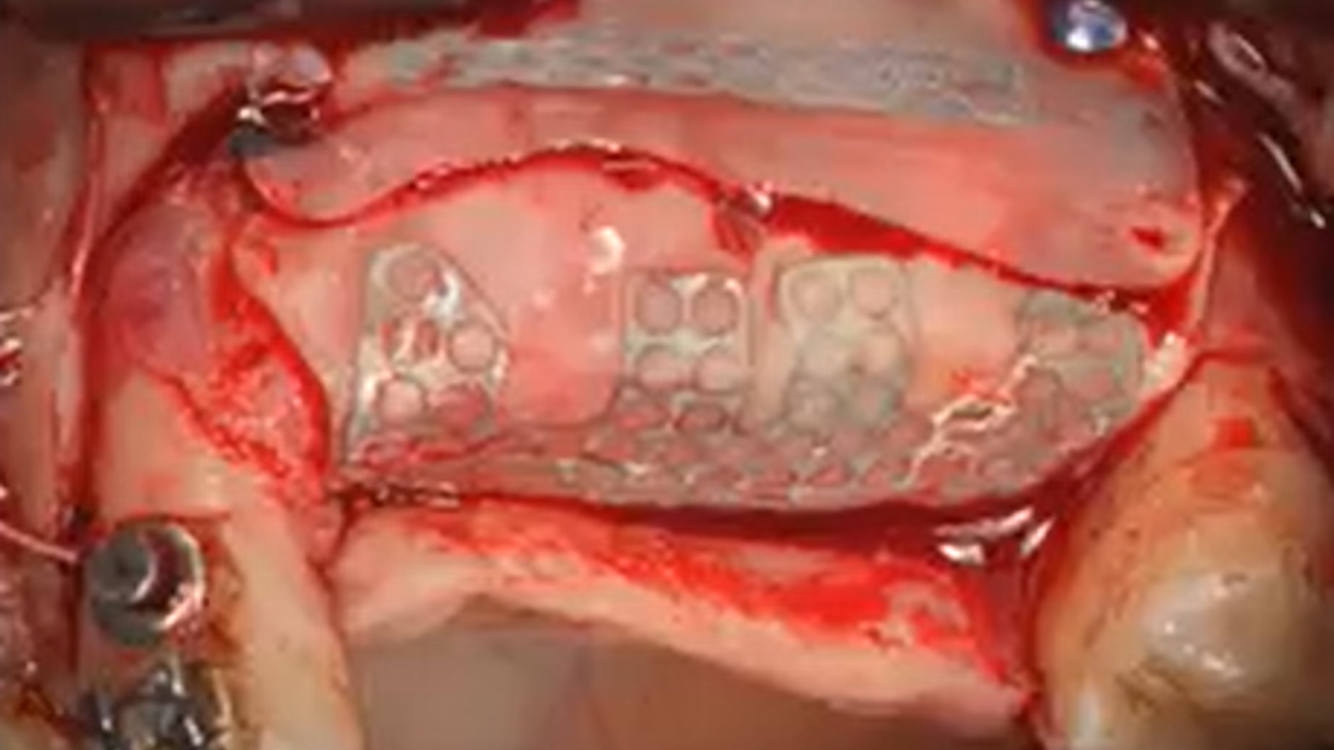 Management of Fenestrations and Dehiscences