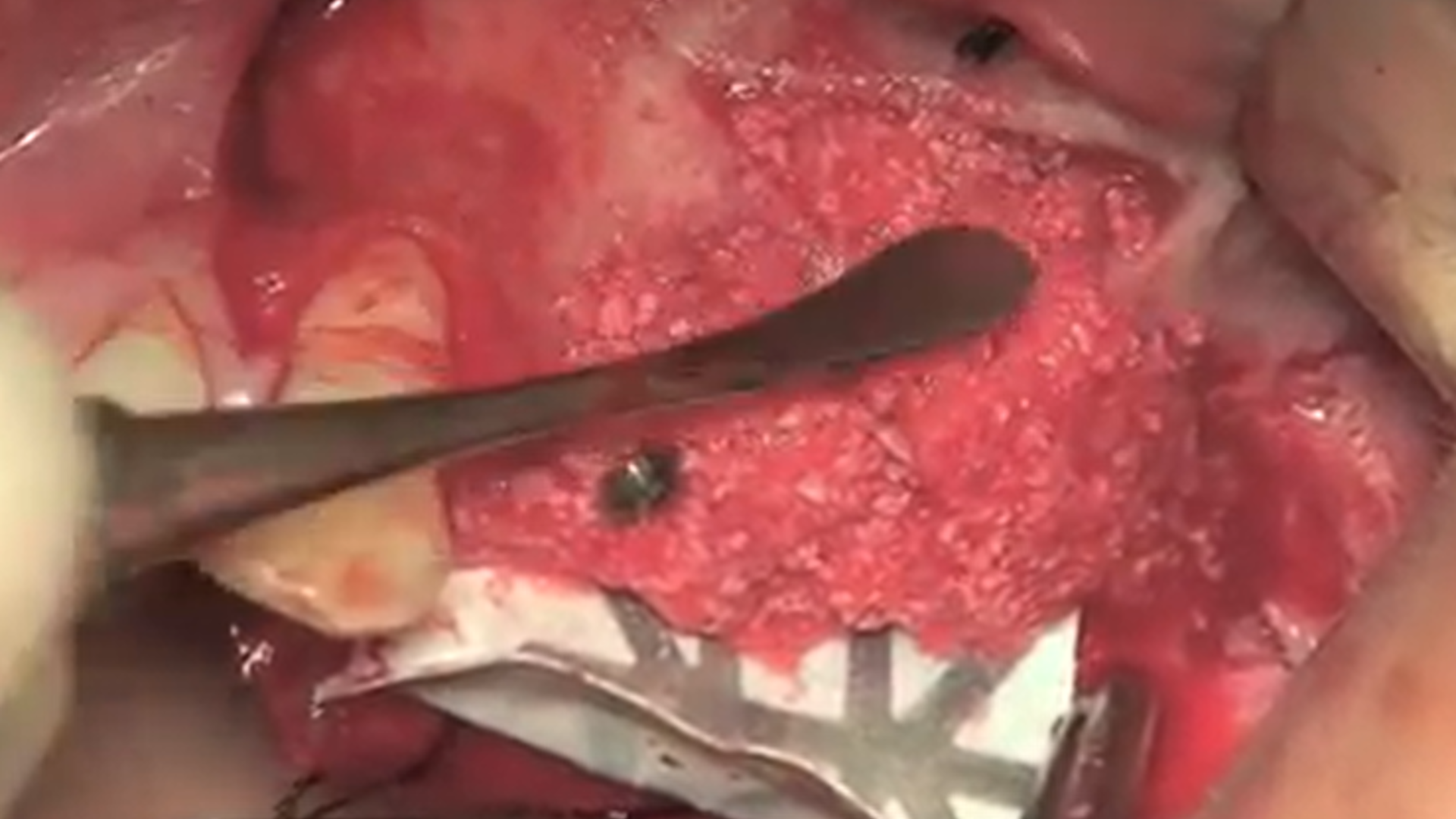 Complex Defects: Vertical Ridge Augmentation and Maxillary Sinus Lift