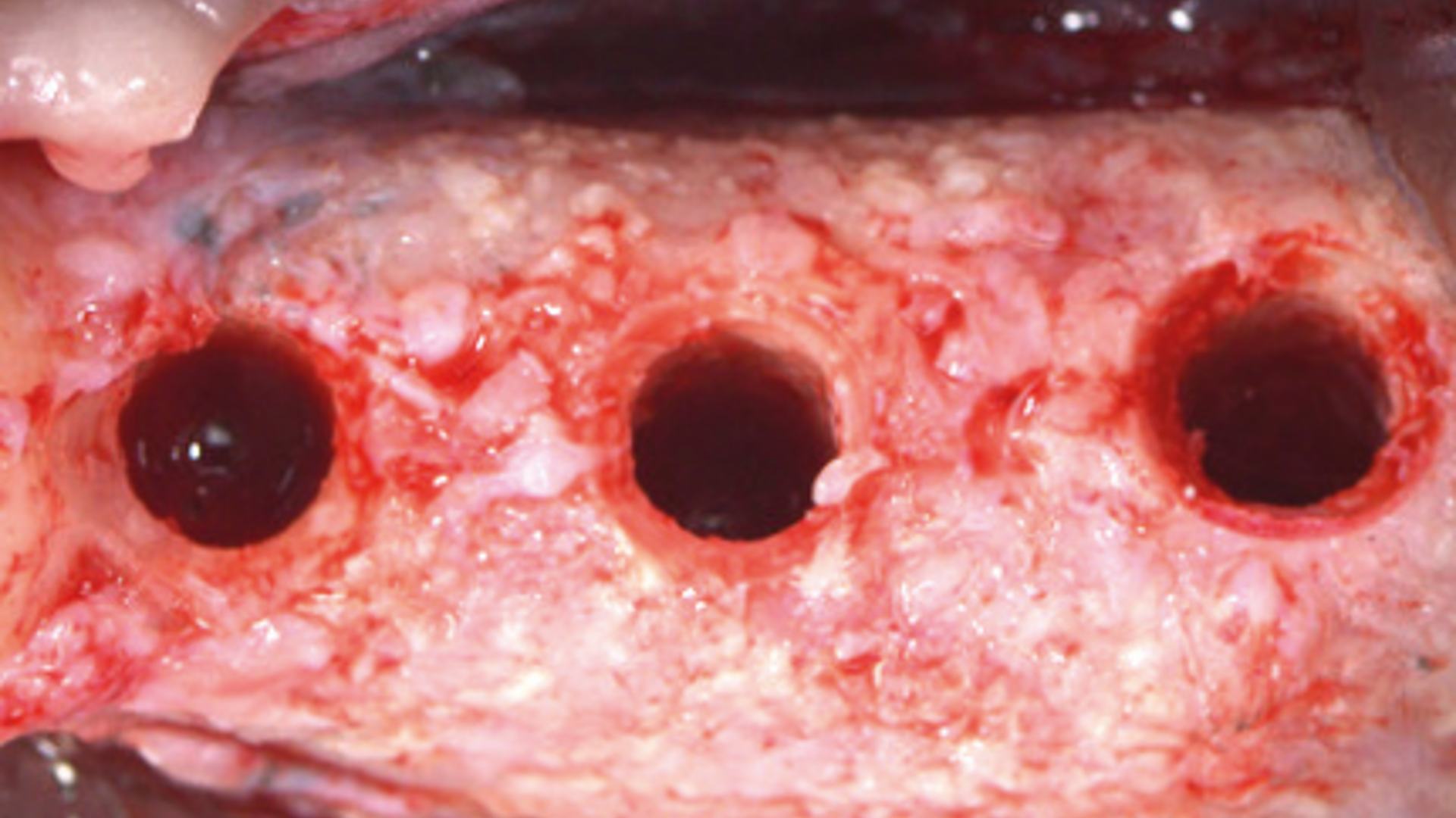 Evolution of Techniques and Materials for Vertical Bone Augmentation