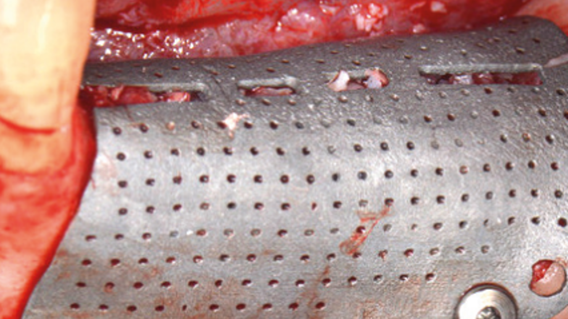 Management of Bilateral Edentulous Sites in the Maxilla