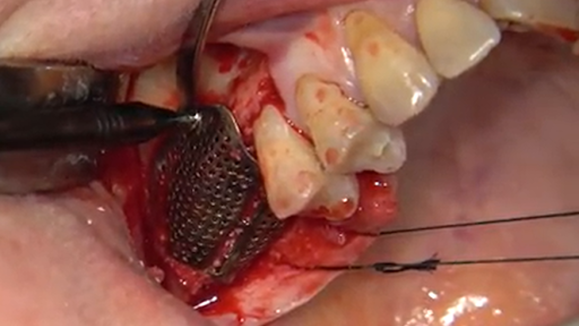 ReLIVE Surgery: Horizontal and Vertical Ridge Augmentation with a Next-Generation Custom Semi-Permeable Titanium Mesh