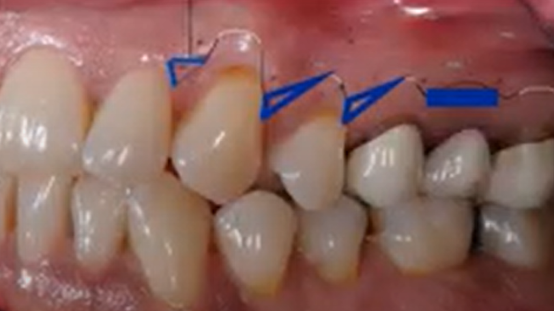 Sinus lift procedures: a comprehensive overview and the potential of different treatment options