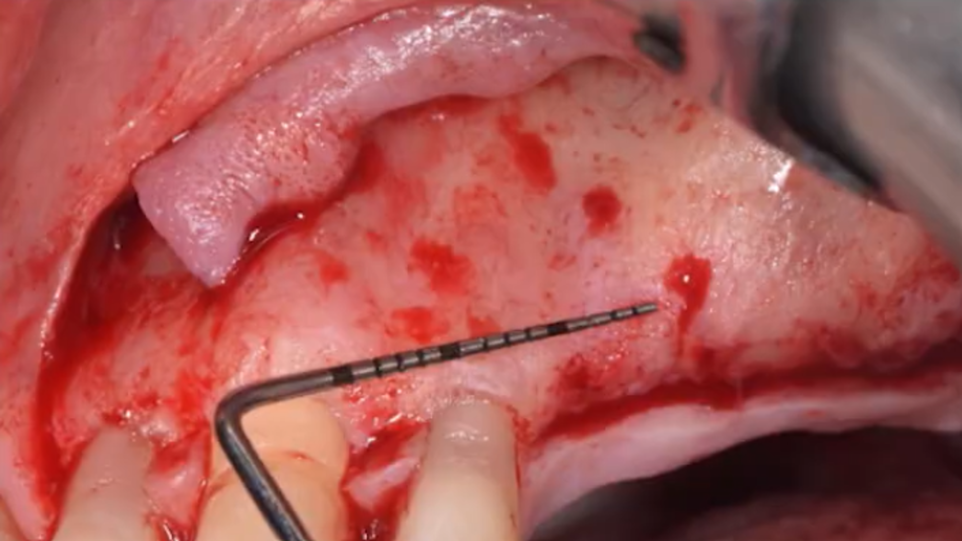The evolution of the Lateral Approach: Lateral Window and Simplified Antrostomy Design