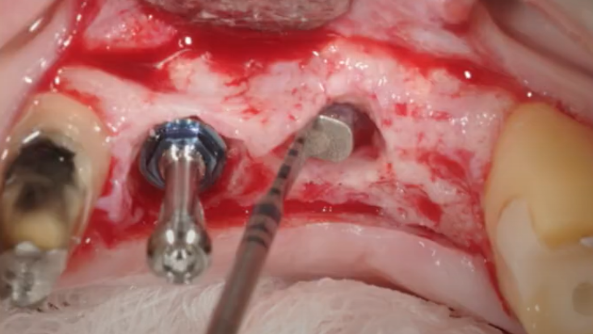 Evolution of sinus lift procedures: Piezo Surgery and Osseodensification