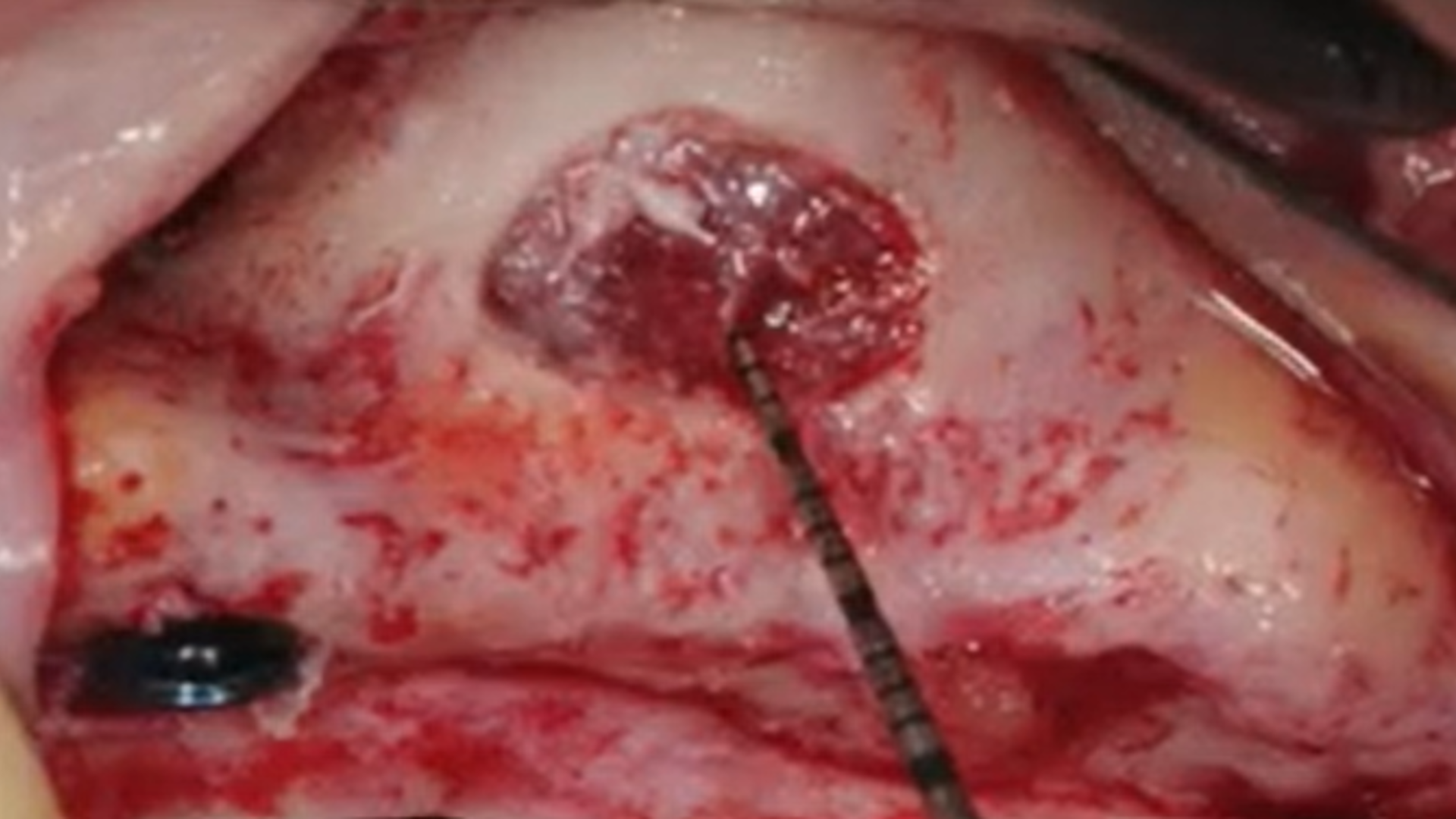 Sinus membrane perforations