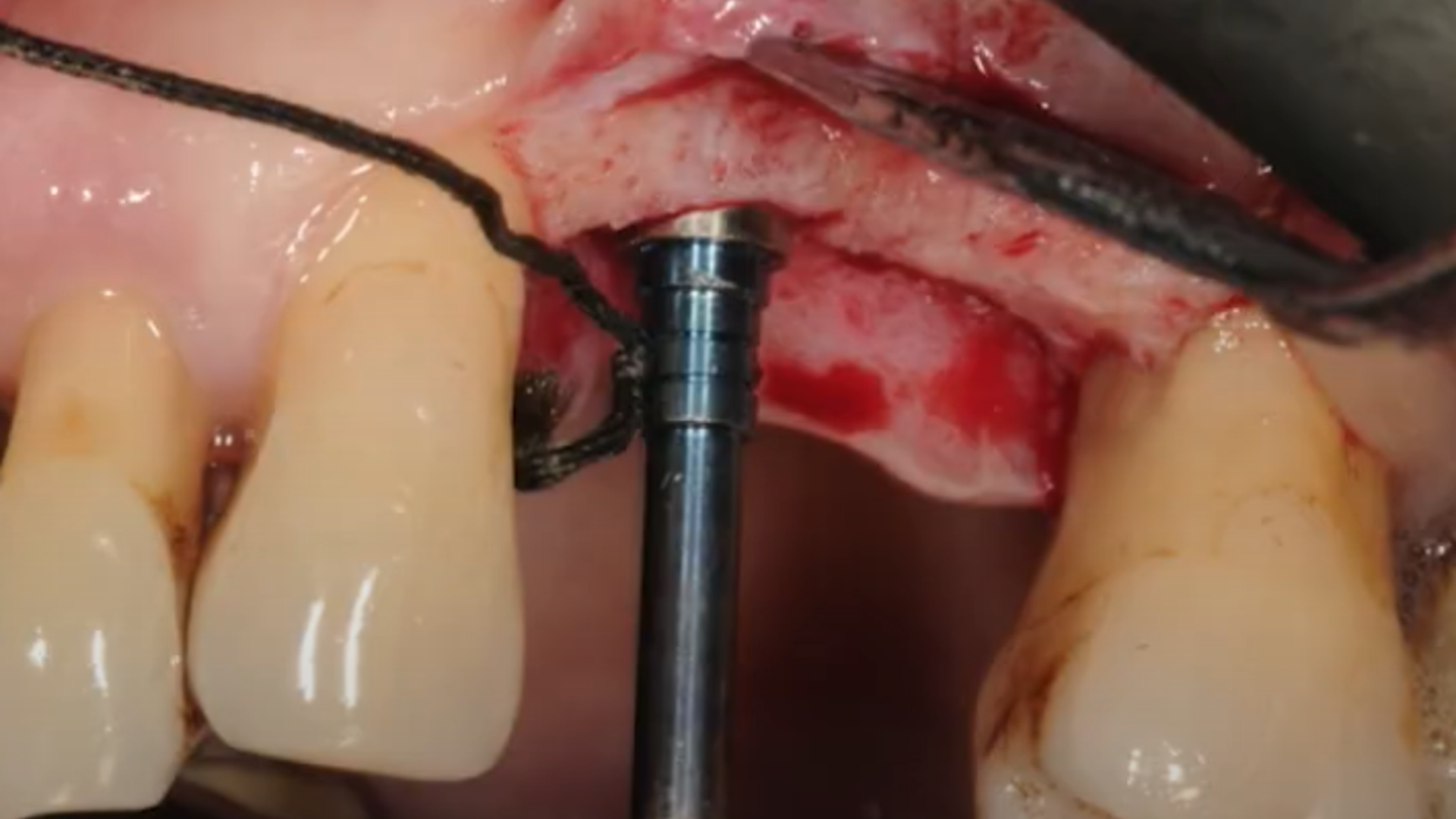 Example of different clinical cases: step-by-step surgical protocol