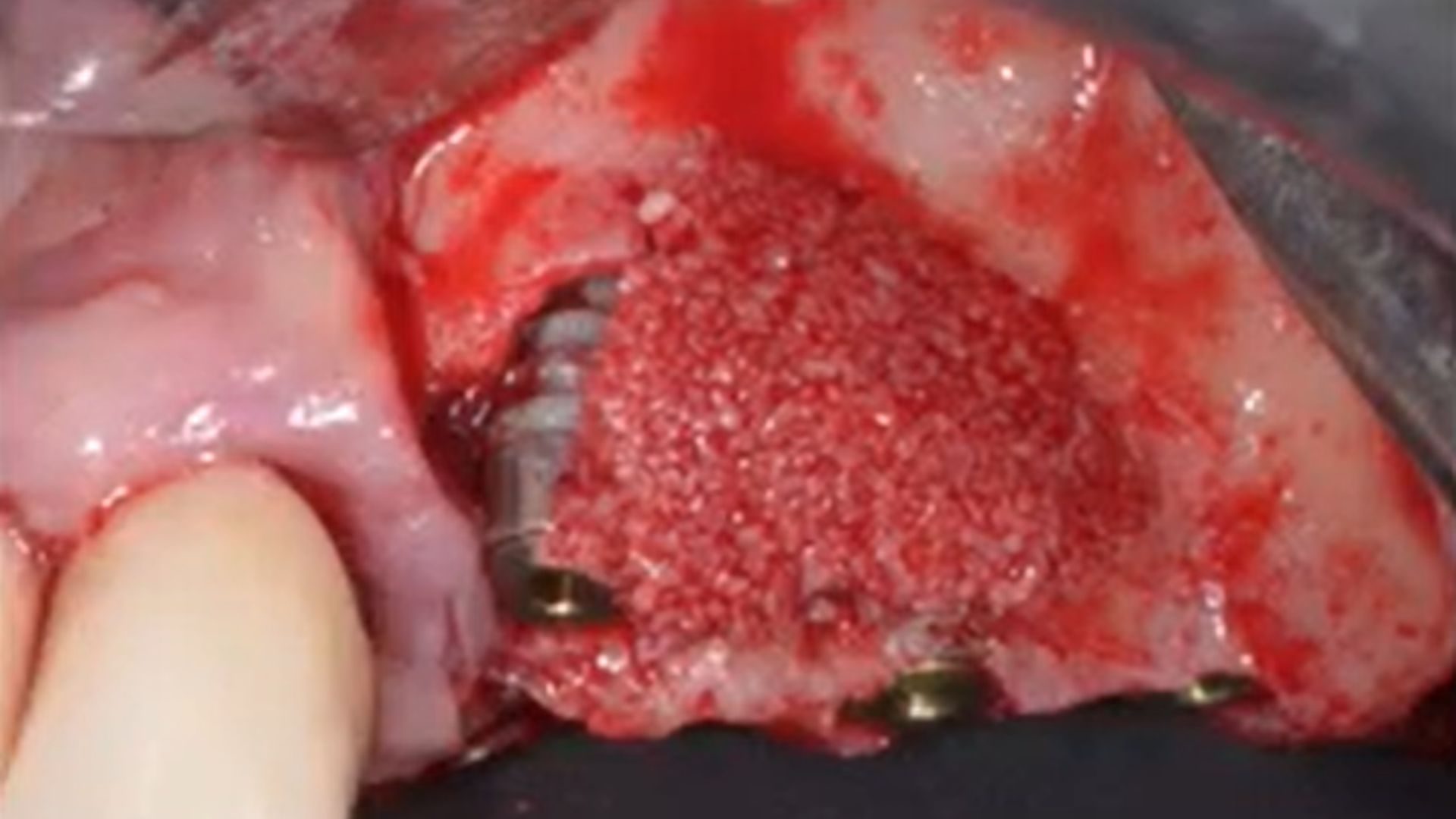 Osseodensification technique