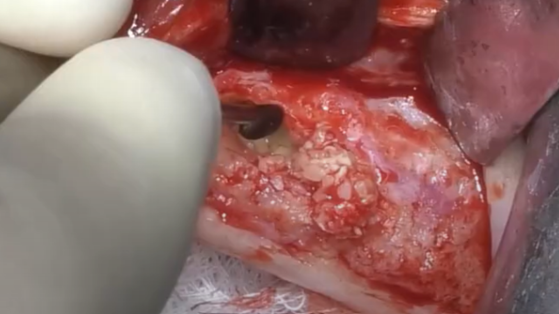 Management of post-op infections after sinus elevation surgery