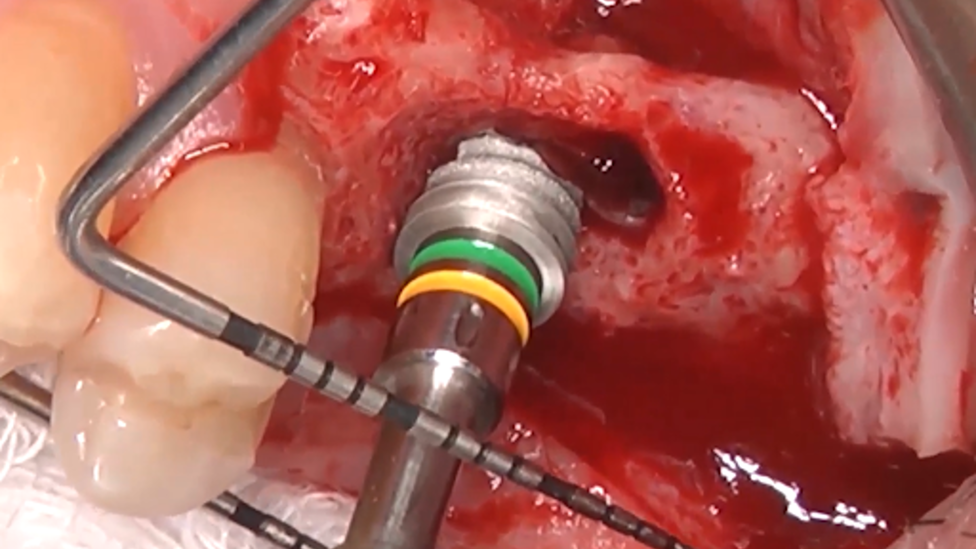 Clinical video: short implants + Versah crestal sinus lift