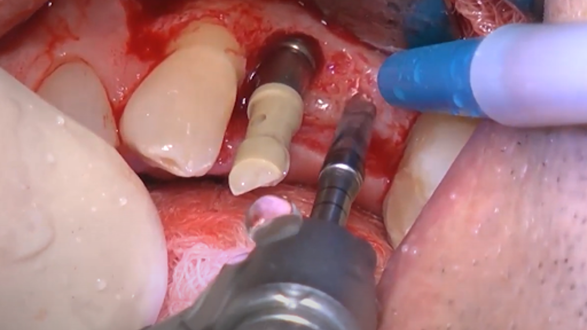 Clinical video: Crestal sinus lift and multiple implant placement