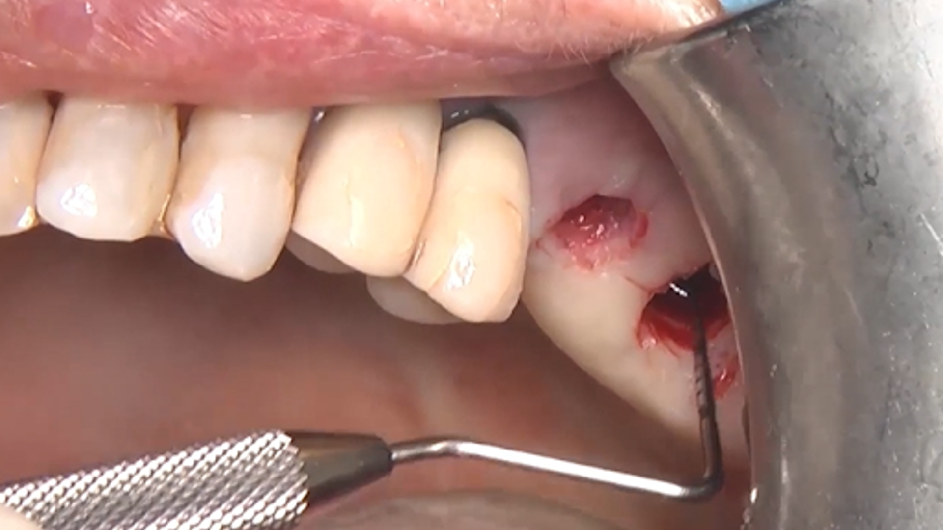 Maxillary sinus elevation: crestal approach with osseodensification