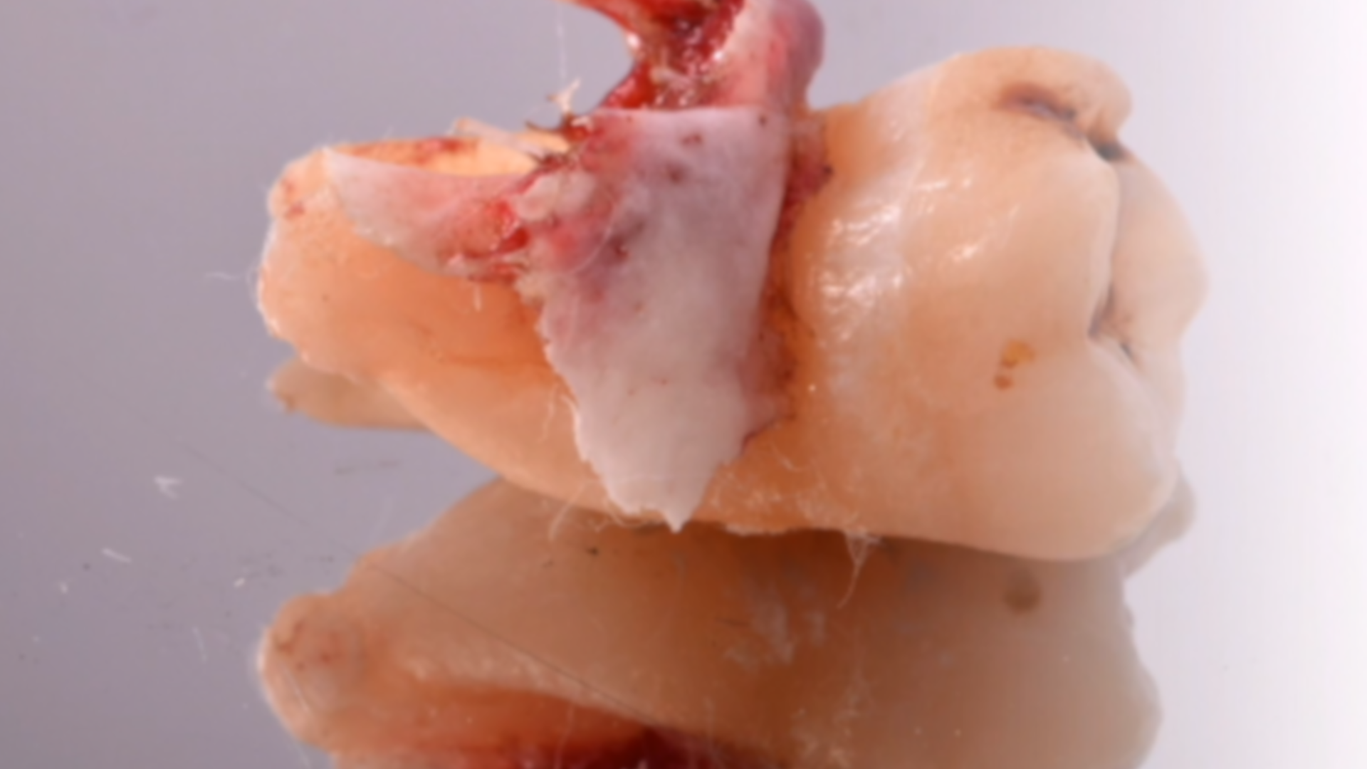 Intra and post surgical complication in extractive surgery