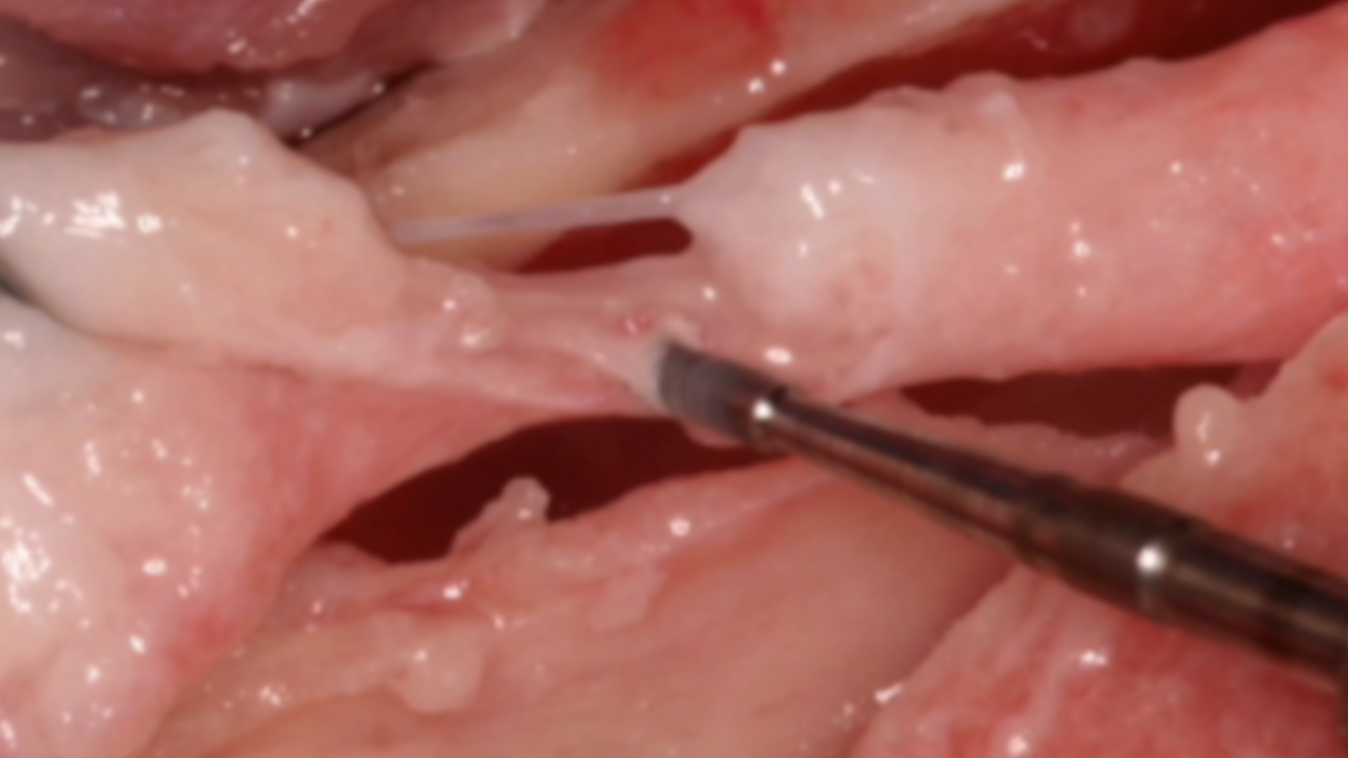 Nerves in extractive surgery