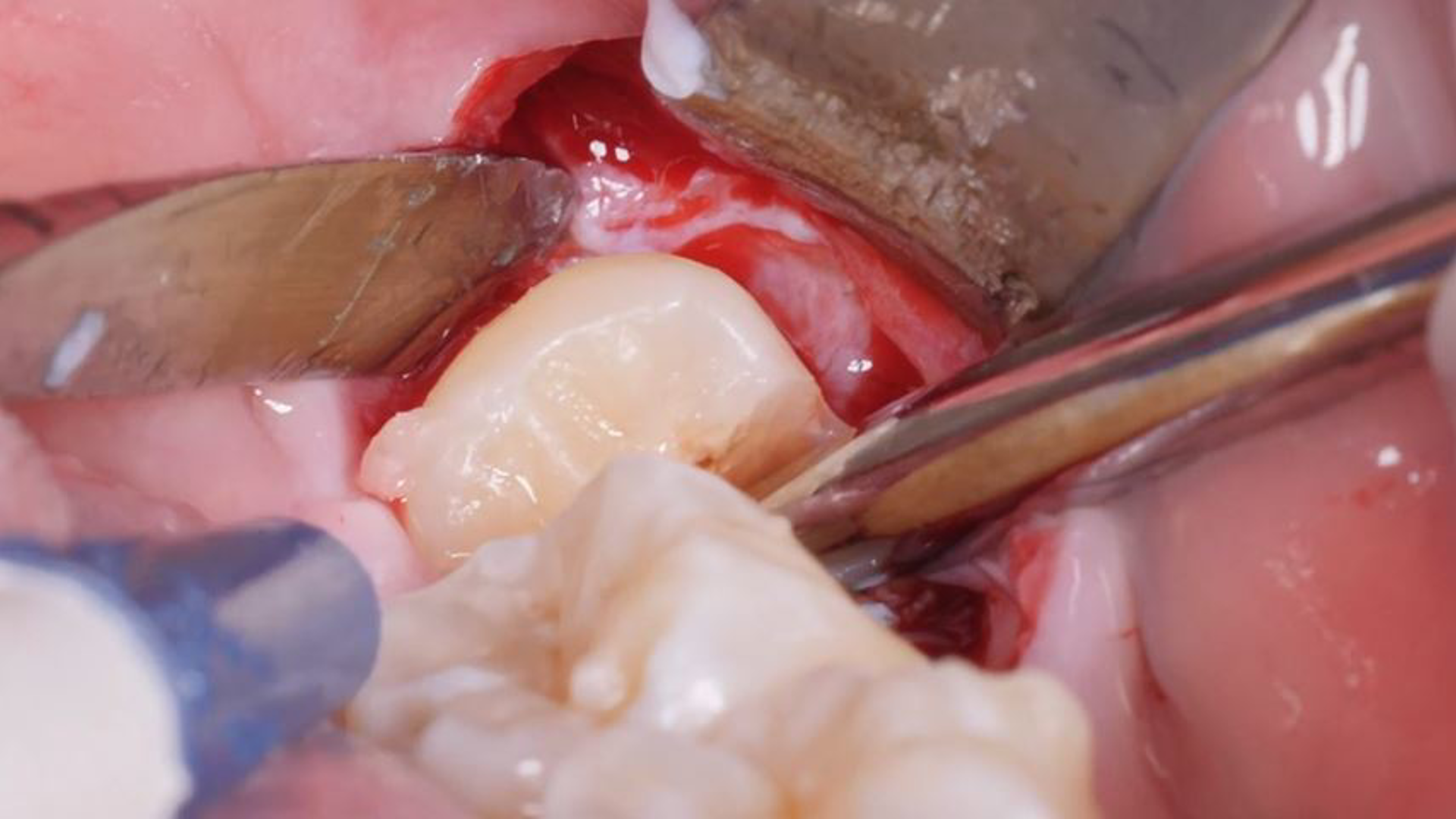 Surgical extraction of impacted mandibular third molar
