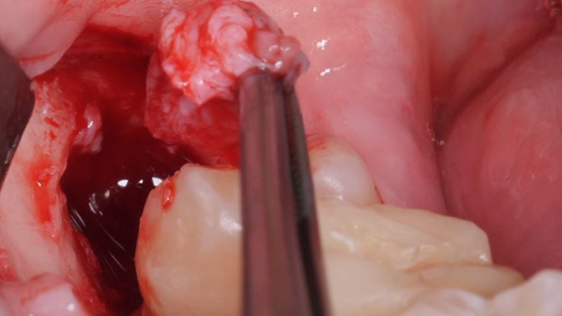 Lower right third molar extraction with deep scar tissue adhesions and fibrosis