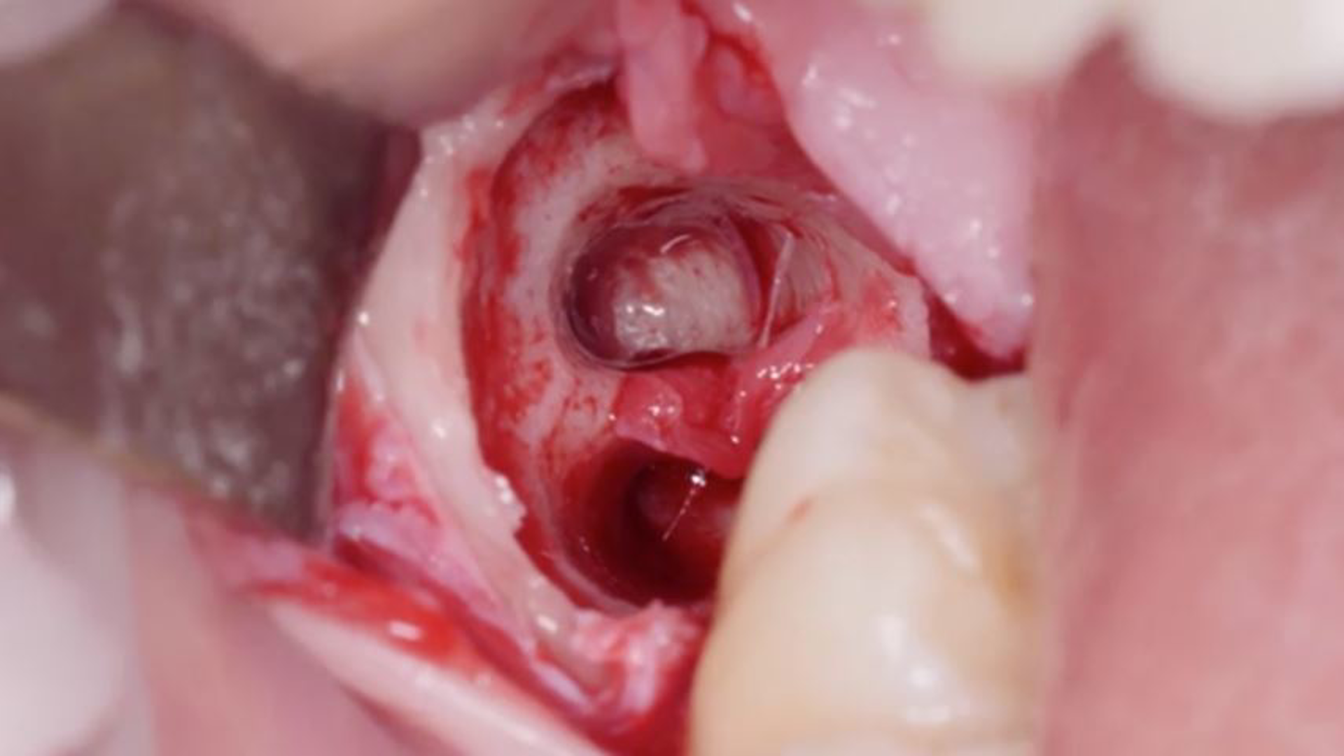 Lower right impacted third molar removal [4 8]