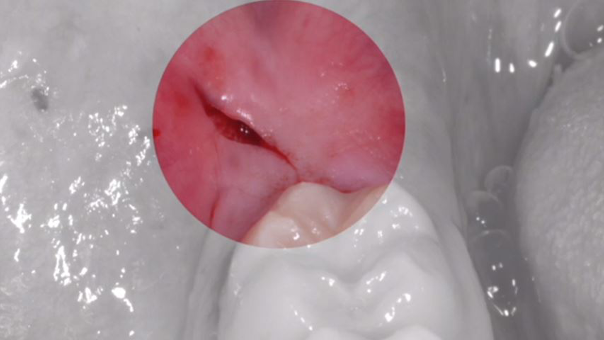 Surgical technique for impacted teeth