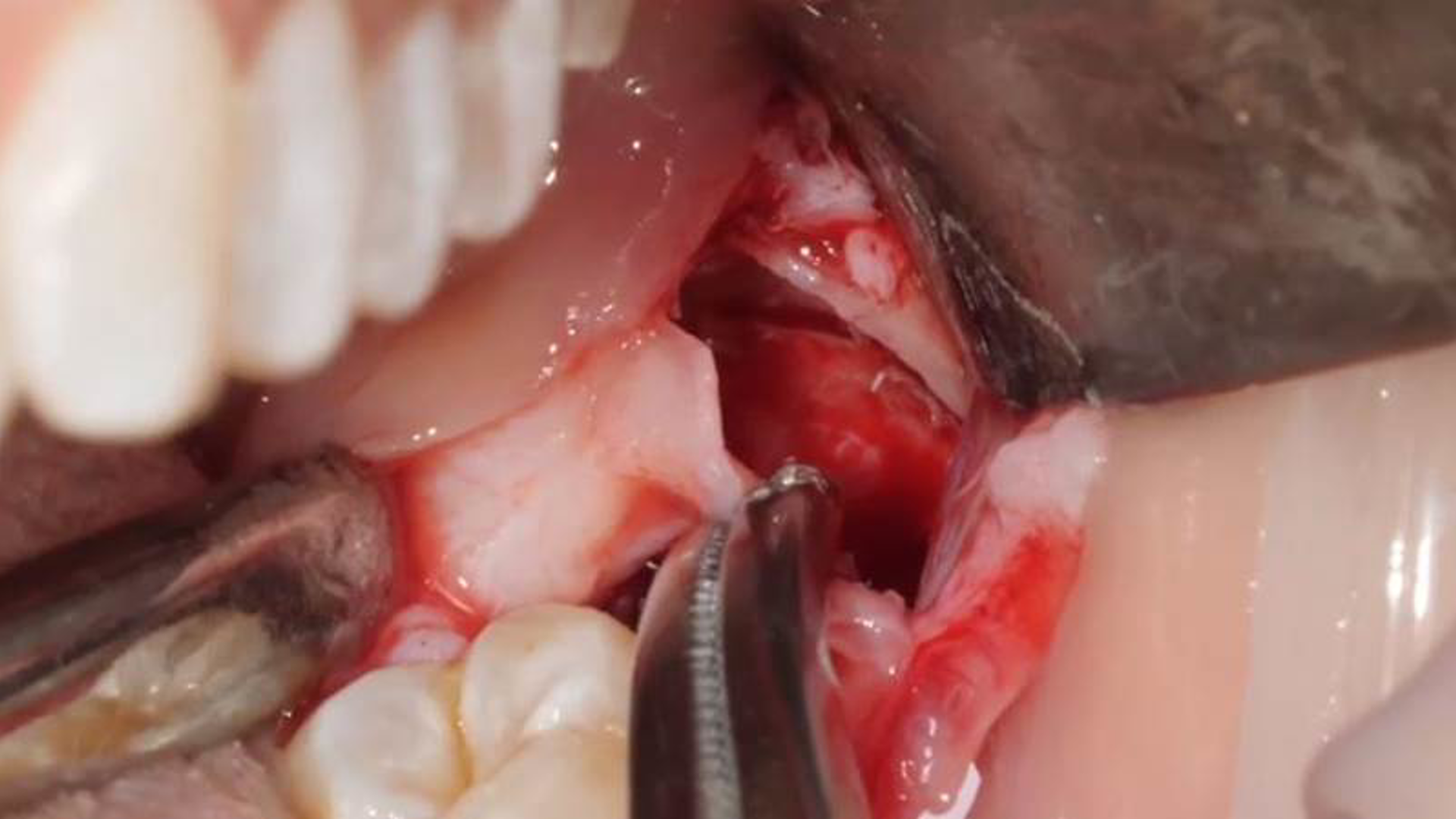 Surgical extraction of element 38: the importance of dental follicle removal