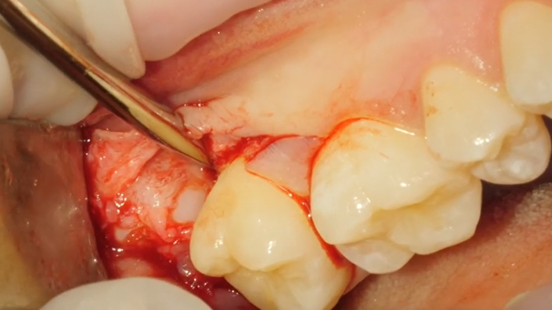 Impacted maxillary third molars: classification, surgical extraction and how to manage complications