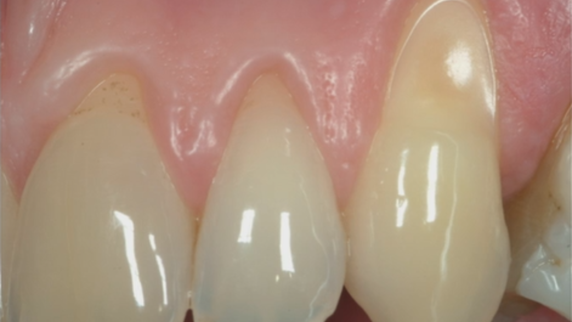 Gingival recession around teeth