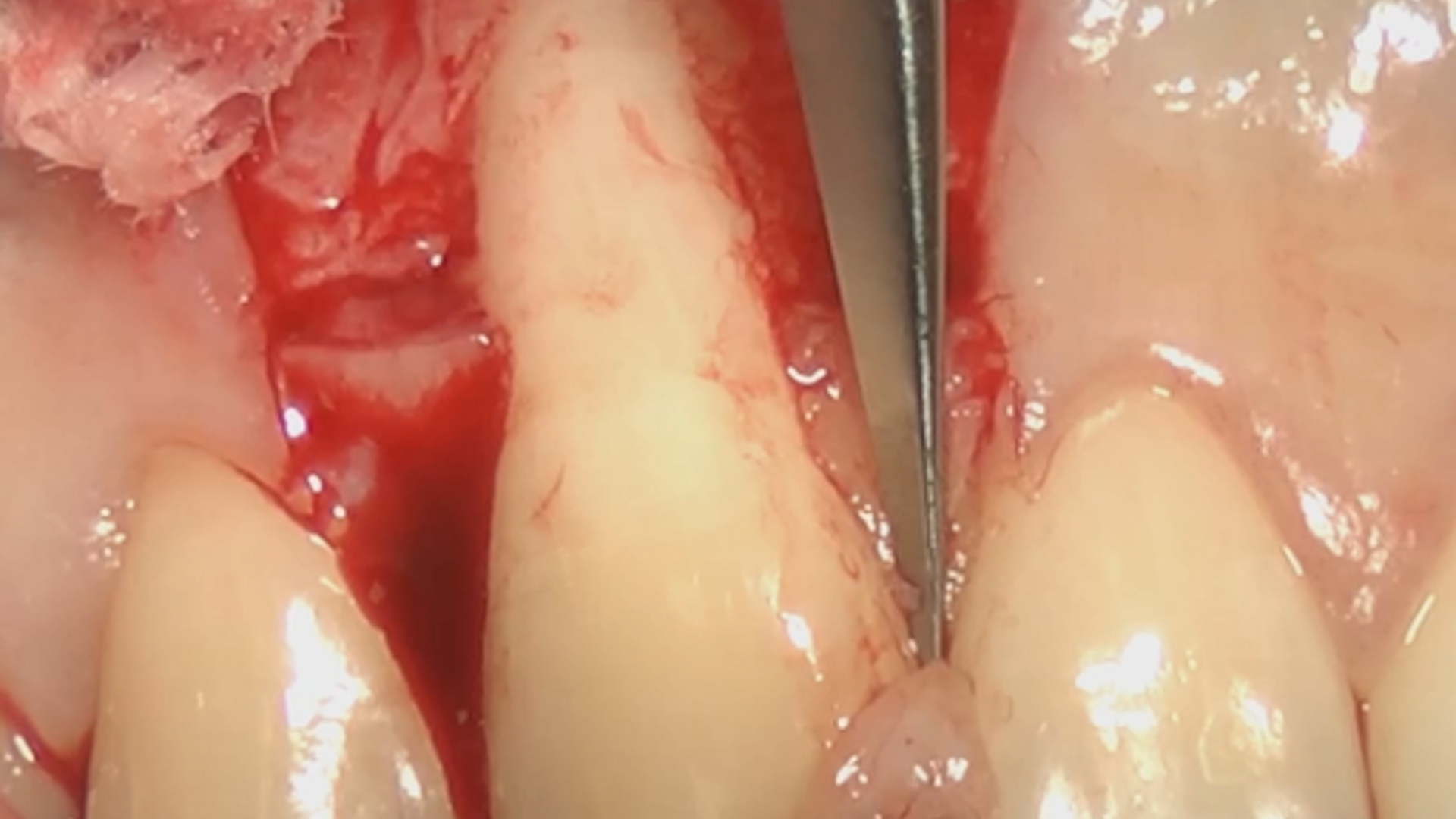 The biological background behind Coronally Advanced Flap