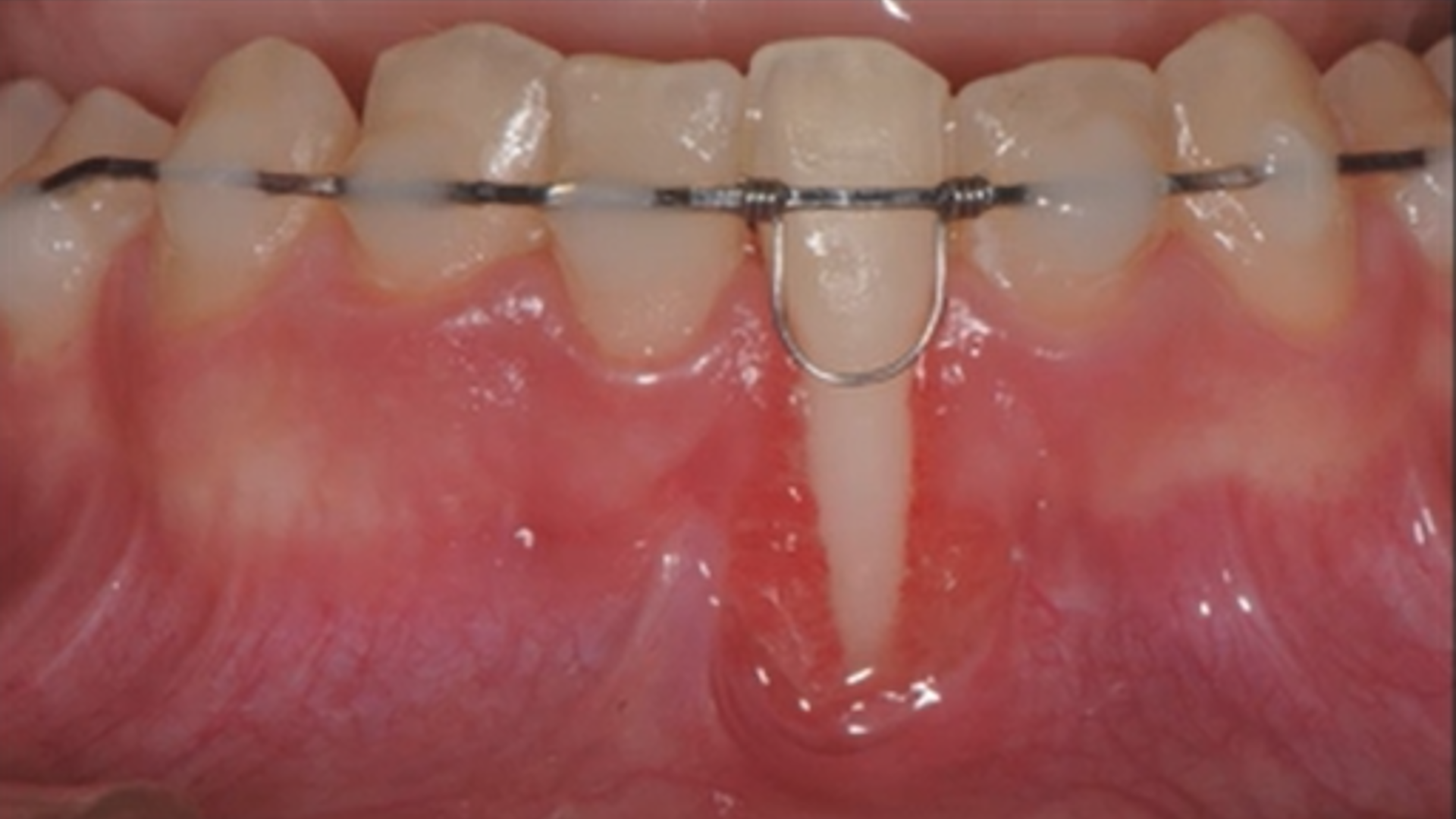 Gingival recession treatment on a lower incisor