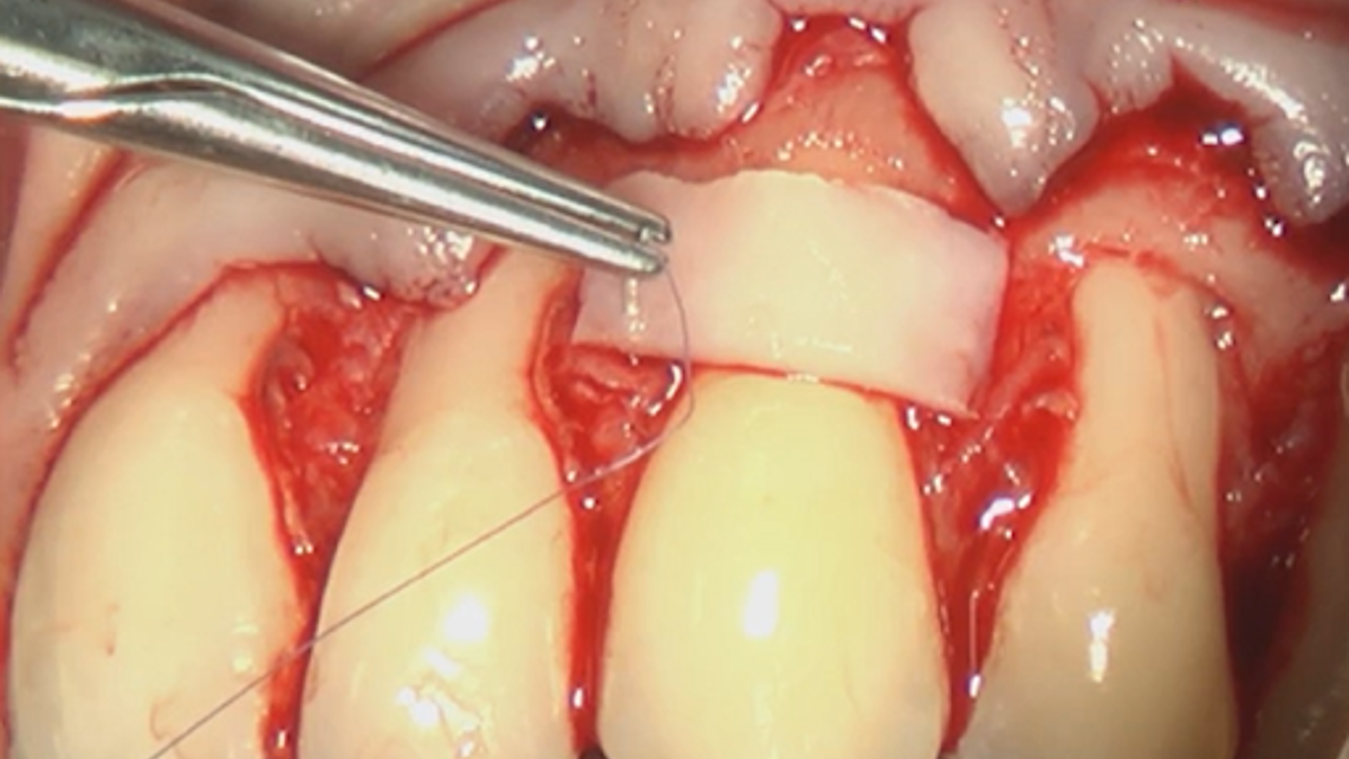 Treatment of multiple gingival recessions in the upper jaw