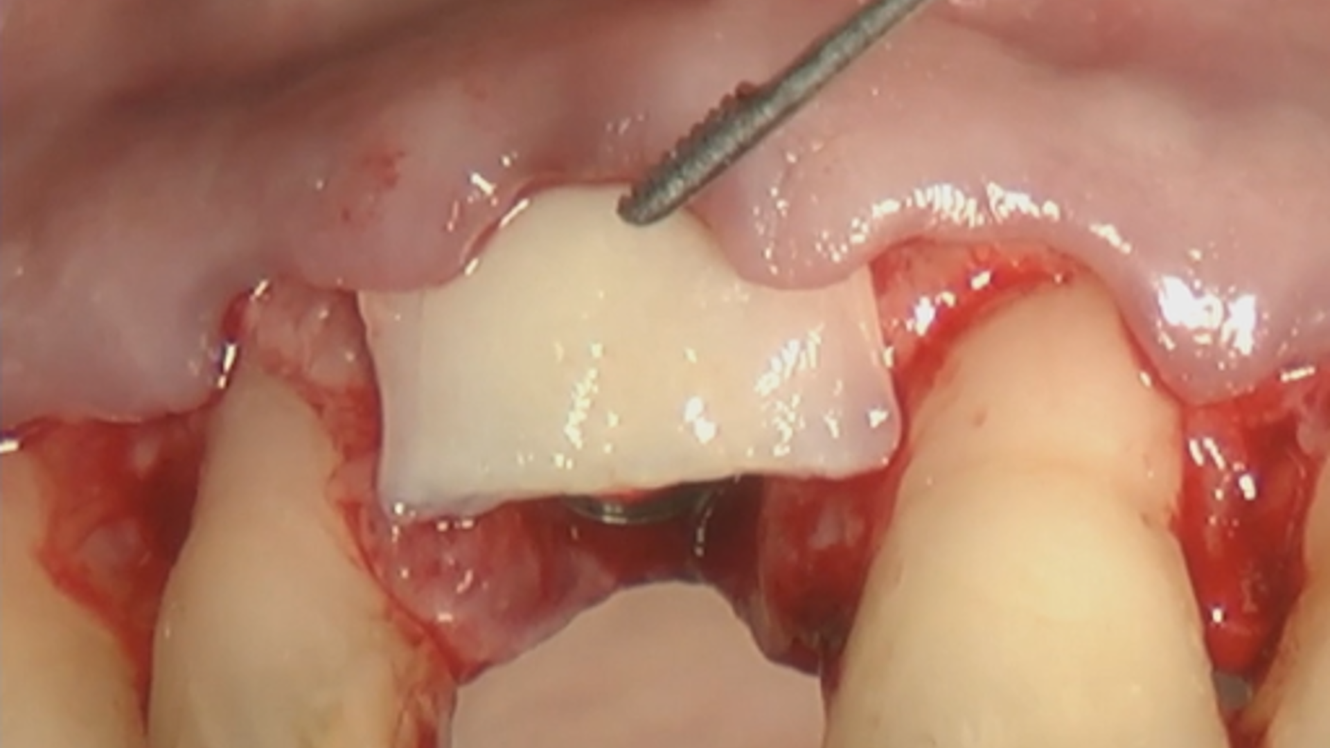Mucogingival approach to immediate implant placement (Part 1)