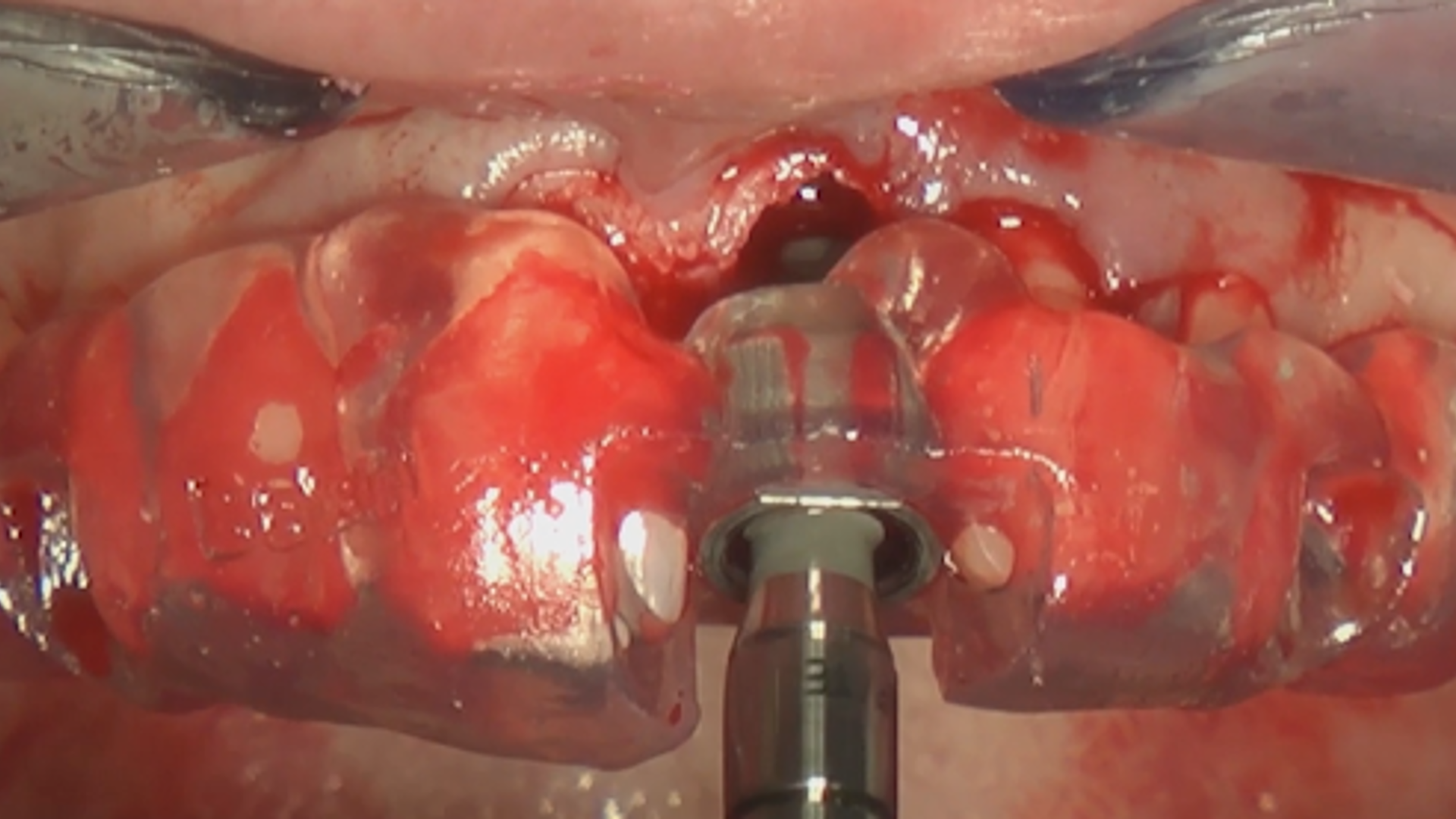 Mucogingival approach to immediate implant placement (Part 2)