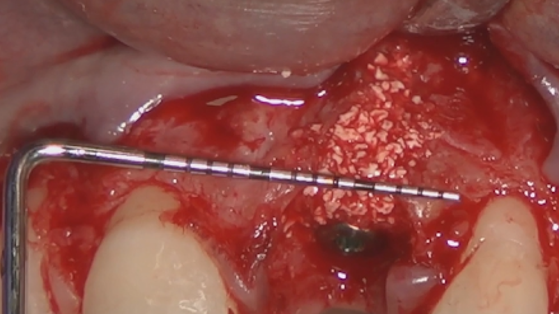  Mucogingival approach to immediate implant placement in problematic clinical cases