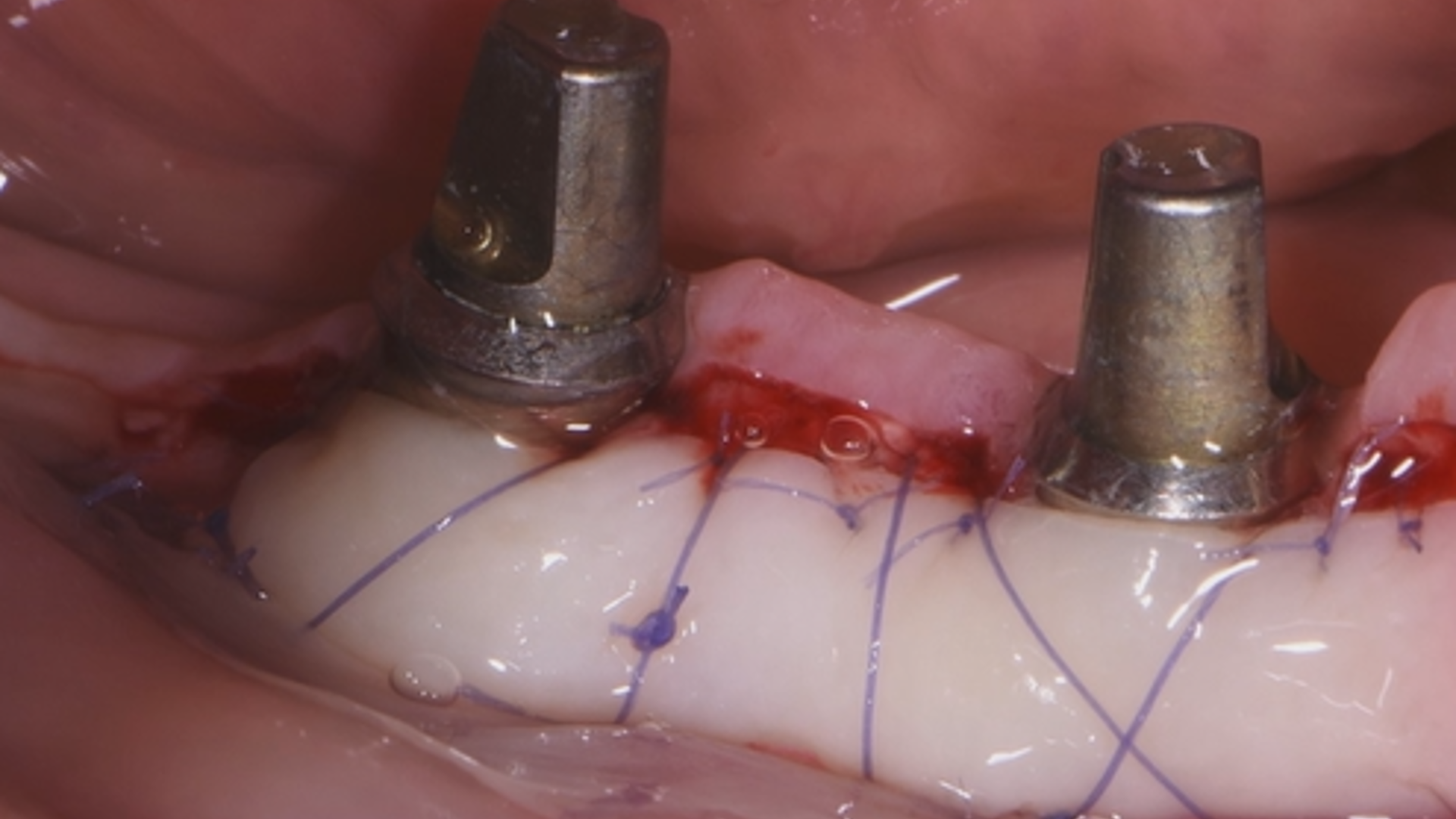 How to increase the supra-periosteal keratinized tissue