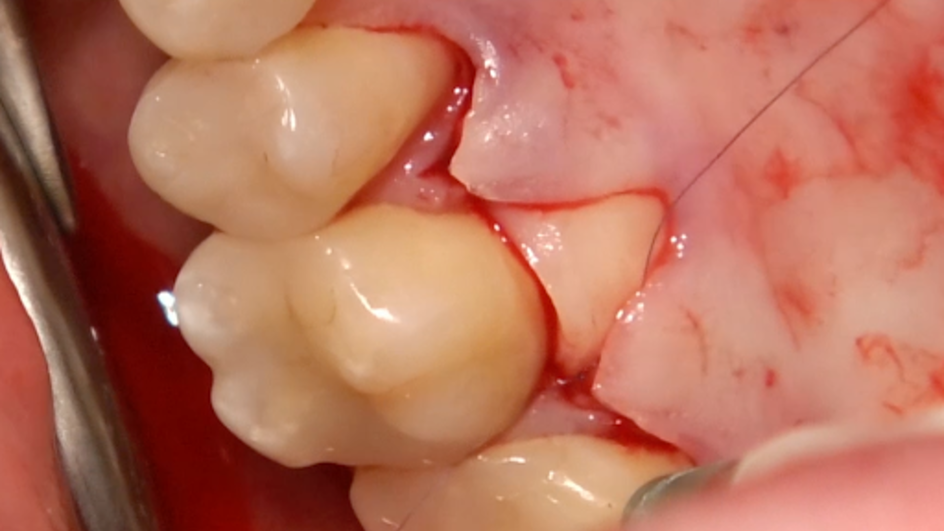 1st ReLIVE Surgery - How to manage a gingival recession in the palatal root