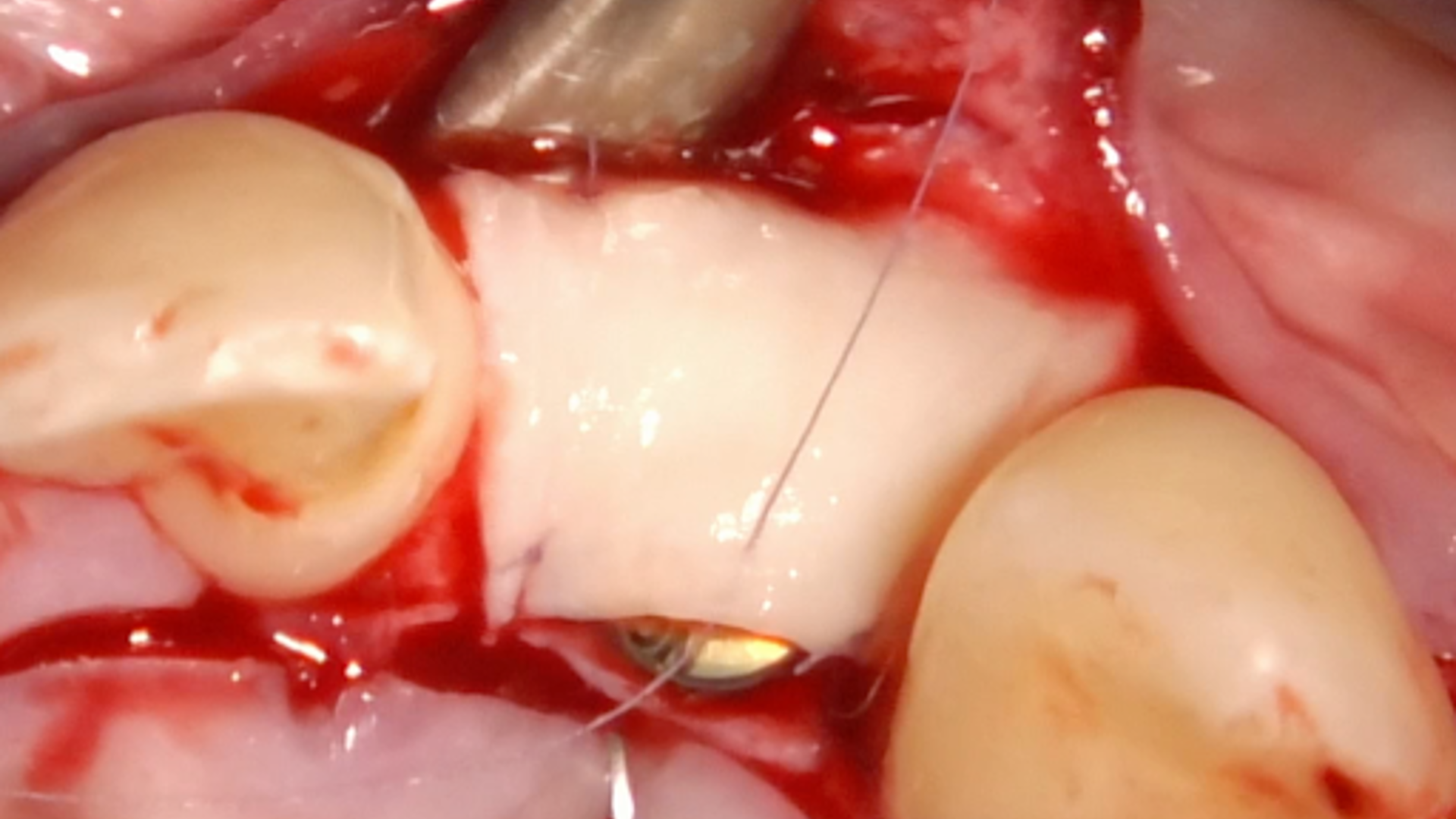 2nd ReLIVE Surgery - Soft tissue augmentation for a guided implant placement at the level of lateral incisor