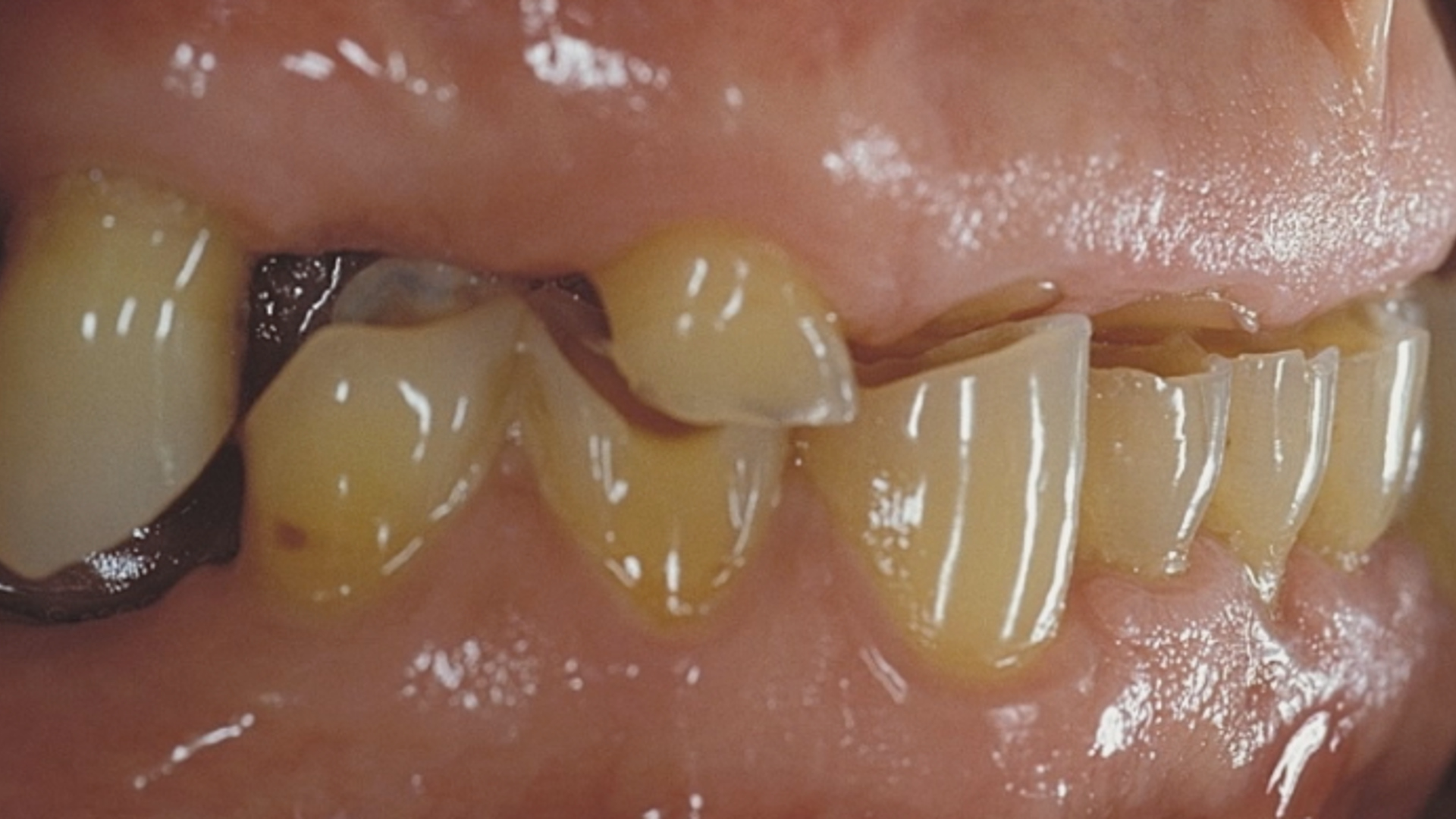 Occlusion vertical size according to MIPP concept
